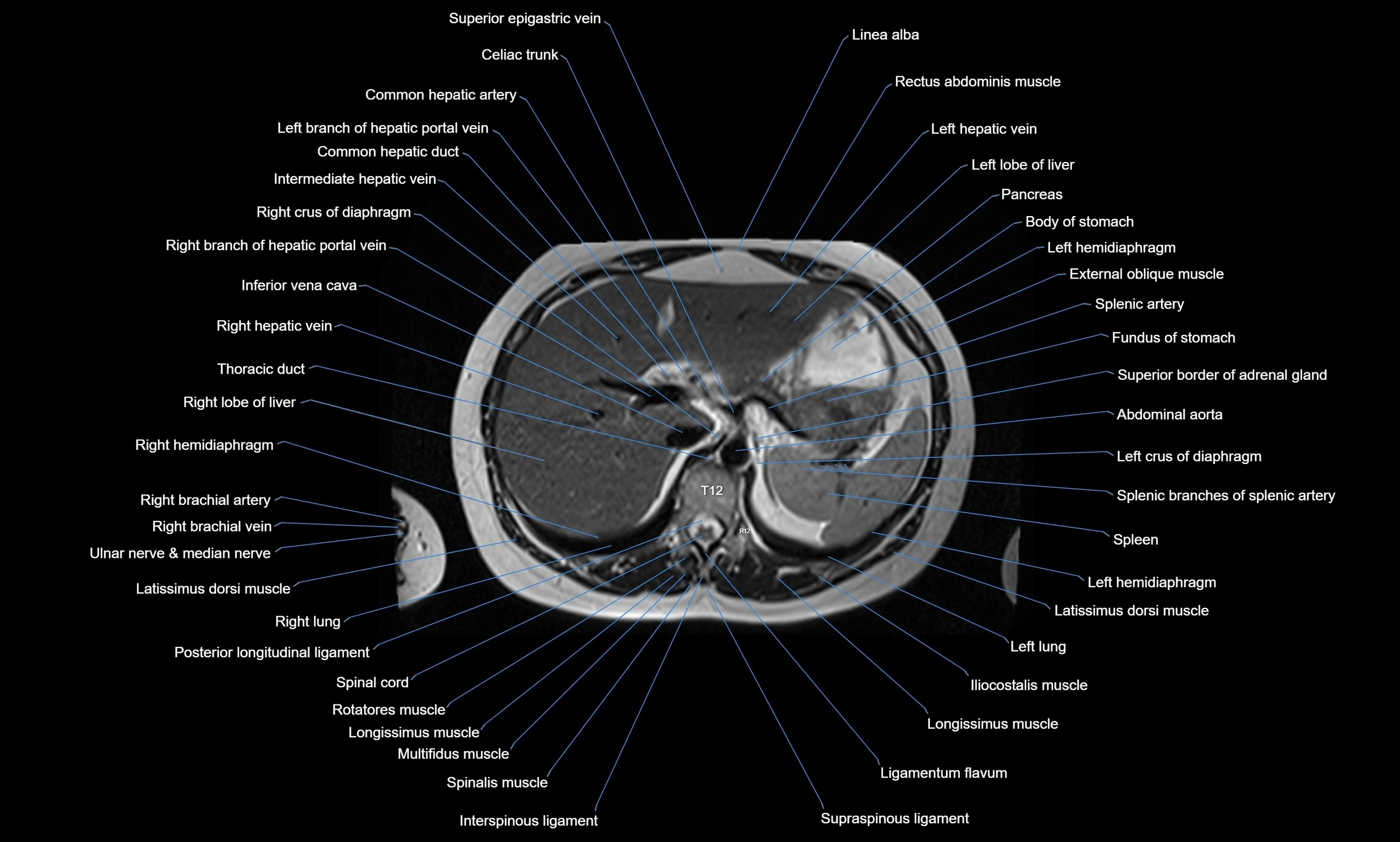 MRI chest axial  cross sectional anatomy 3T radiology  image-img-00001-00043.webp